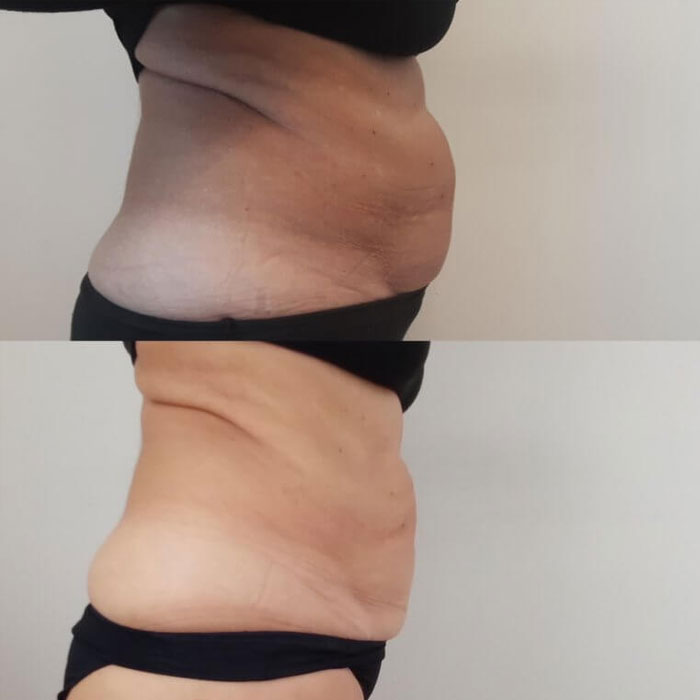 trusculpt előtte utána