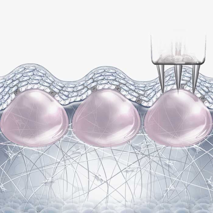 mikropengés nanosoft bőrfiatalítás kép arckezelés