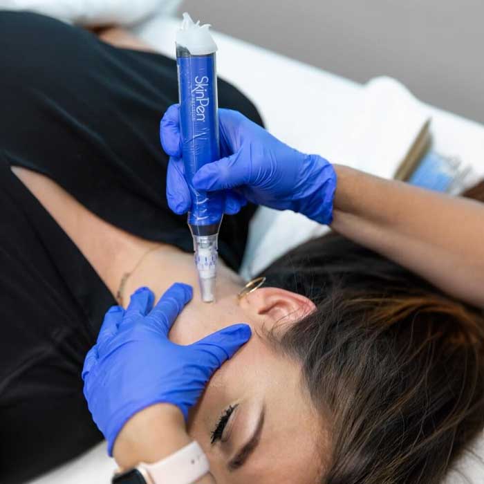 skinpen kezeles