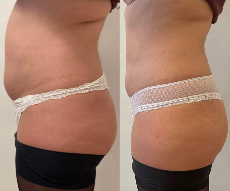 1 kezelés eredménye 1 hét elteltével LaserSure+Isculpt
