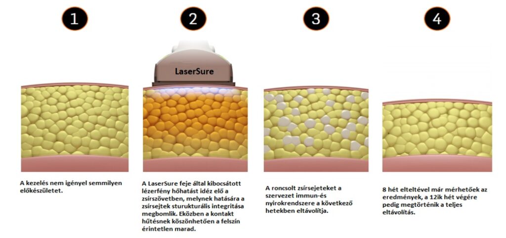 lasersure folyamat