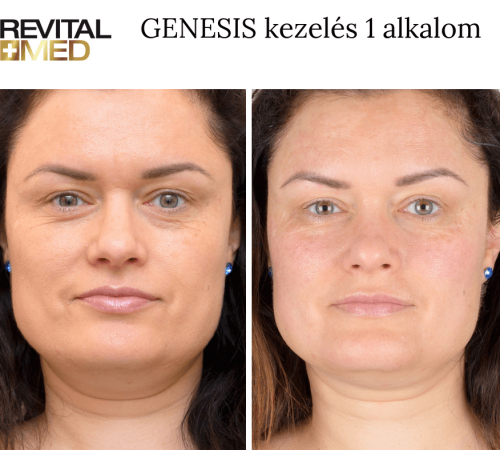genesis előtte utána kép