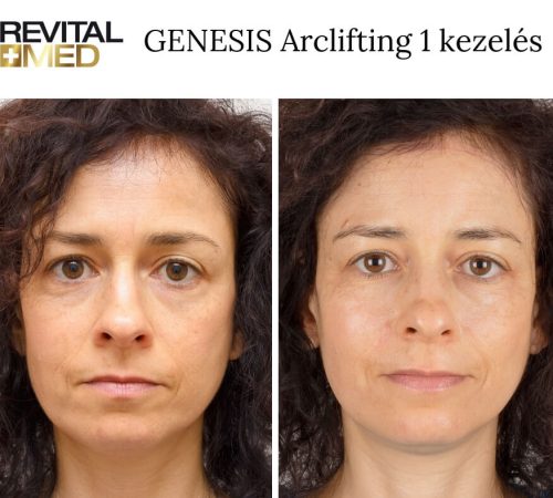 genesis előtte utána kép
