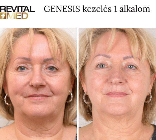 genesis előtte utána kép